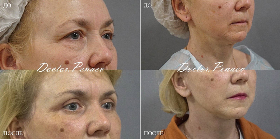 Пациентка пластического хирурга Арслана Пенаева до и после подтяжки лица