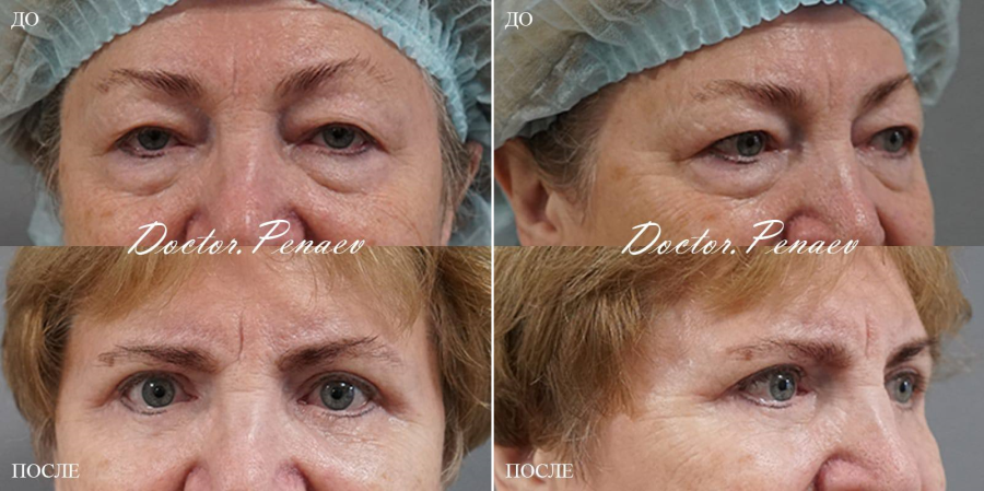 Пациентка (61 год) профессора Арслана Пенаева до и после белфаропластики