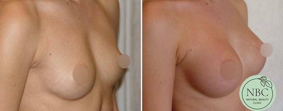 Пациентка доктора Арслана Пенаева после операции по увеличению груди имплантами