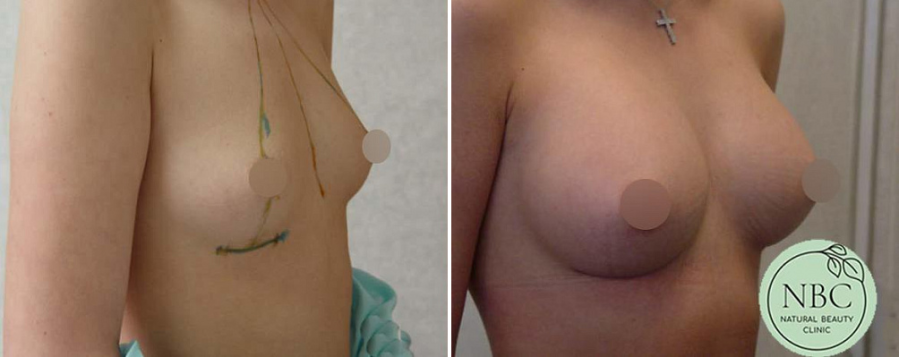 Пациентка доктора Арслана Пенаева после операции по увеличению груди имплантатами.