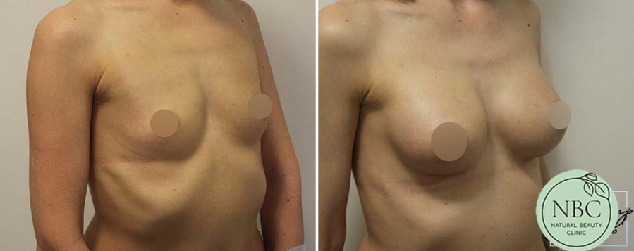 Пациентки пластического хирурга Арслана Пенаева после увеличения груди имплантатами.