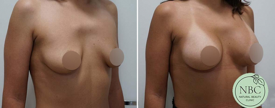 Пациентка пластического хирурга Арслана Пенаева после операции по увеличению груди имплантатами.