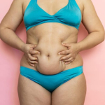 Методы абдоминопластики: от мини до классического варианта