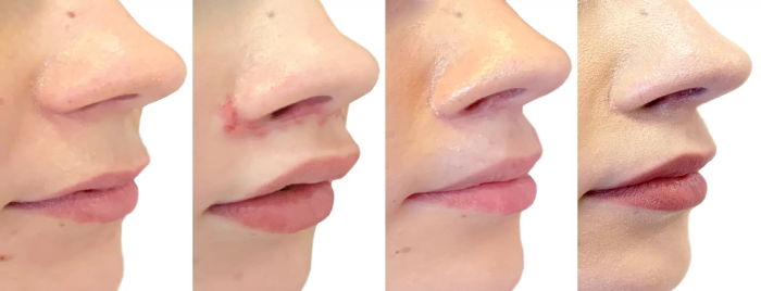 Булхорн: операция по увеличению губ