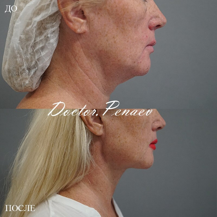 Пациентка доктора Арслана Пенаева до и после мультитехнологичной пластики лица