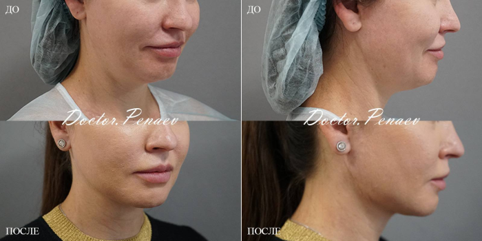 Пациентка доктора Арслана Пенаева до и после мультитехнологичного лифтинга лица