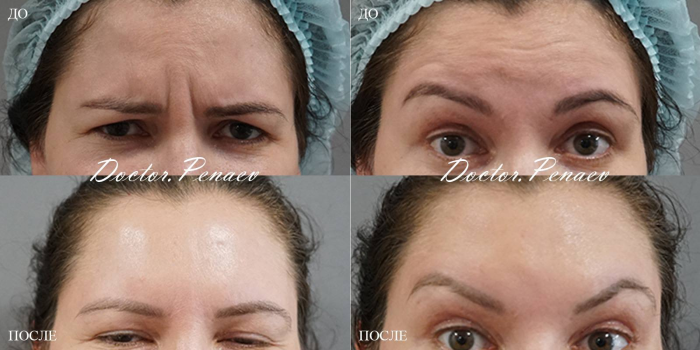 Пациентка доктора Арслана Пенаева до и после авторской методики Вечный ботокс