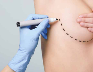 Субмаммарный доступ при увеличении груди