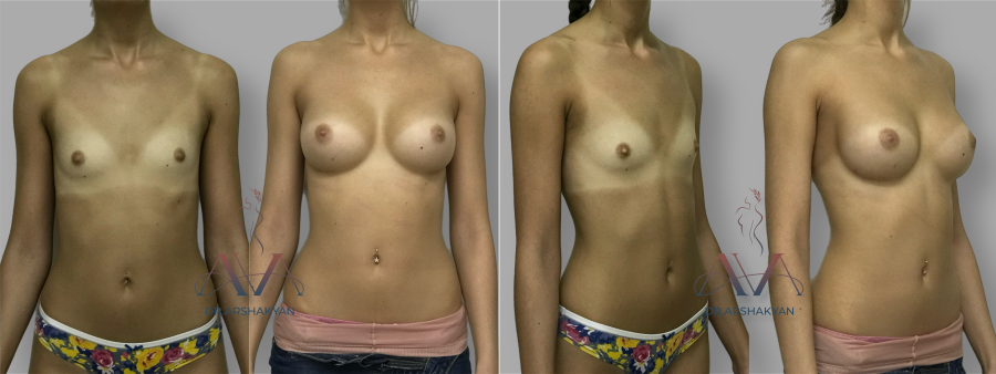 Пациентка пластического хирурга Вардана Аршакяна до и после увеличения груди по запатентованной методике Natural Beauty