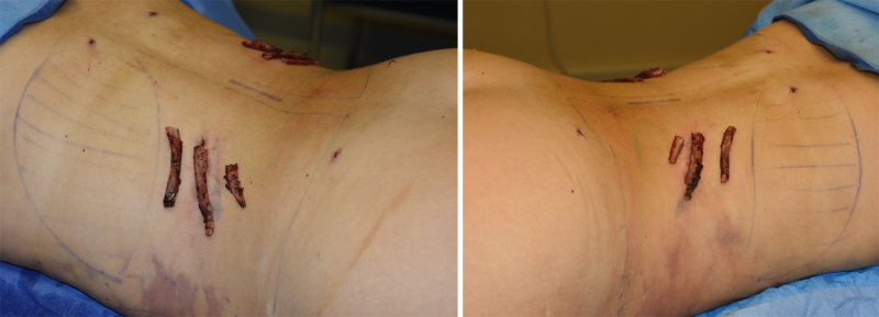 Пациентка после операции по удалению ребер. Иллюстративное фото.