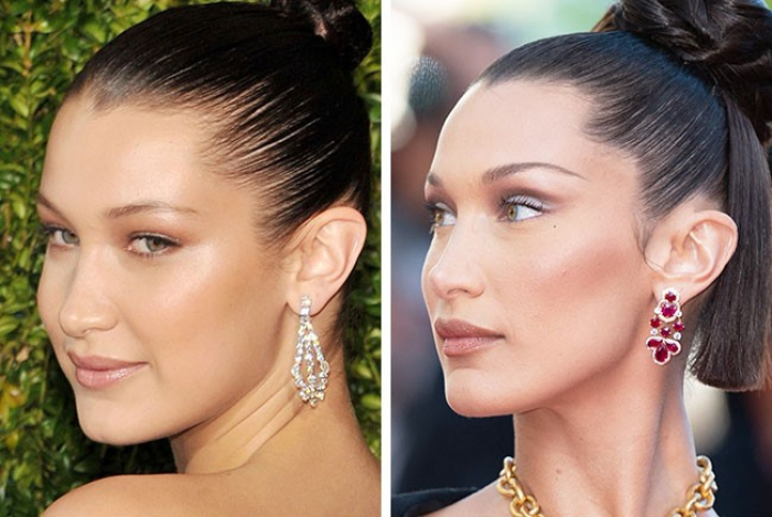 Удаление комков Биша у Беллы Хадид