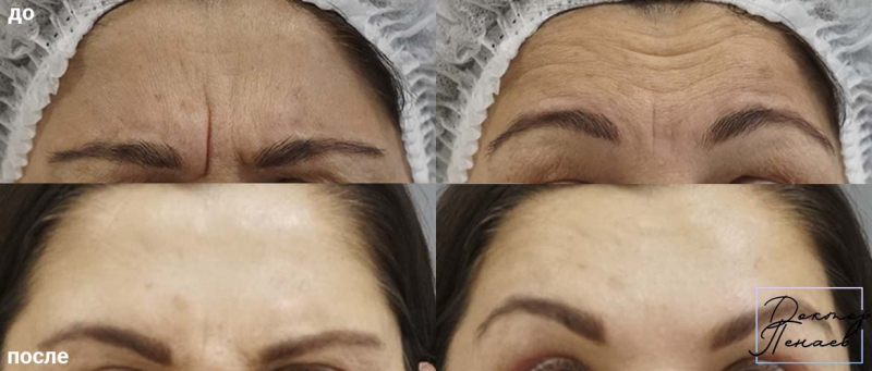 Пациентка доктора Пенаева до и после процедуры Вечный Ботокс