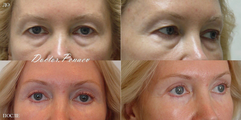 Пациентка доктора Пенаева до и после омоложения век.