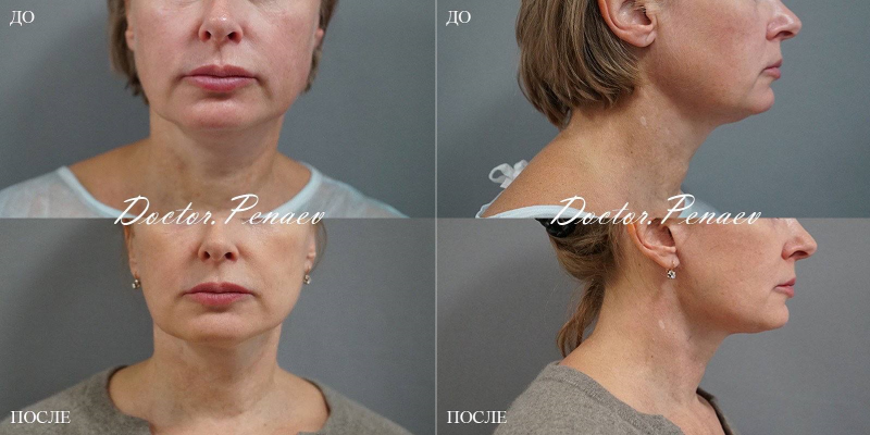 Пациентка доктора Пенаева до и после смас-пластики лица