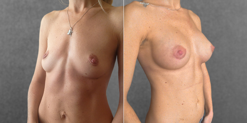 Пациентка доктора Дмитрия Крысина до и после увеличения груди имплантами