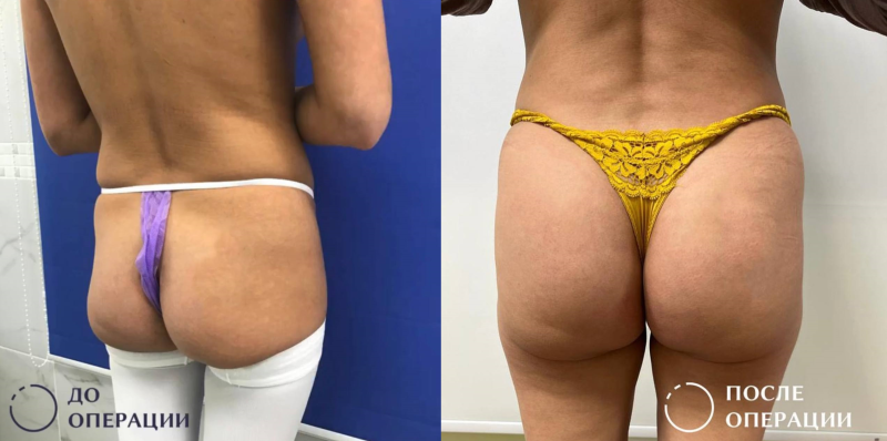 Пациентка хирурга Дмитрия Крысина до и после увеличения ягодиц имплантами