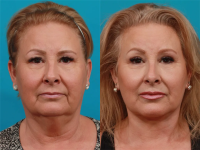 Пациентка пластического хирурга Гукаса Миракяна. Фото до и после операции по подтяжке лица