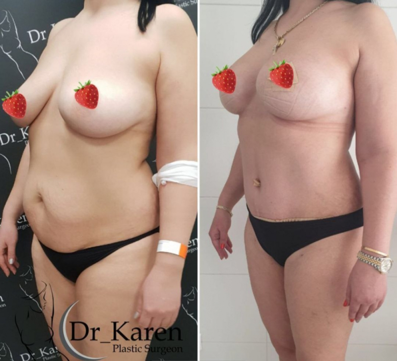 Пациентка пластического хирурга Карена Пайтяна до и после операции «Постнатал».