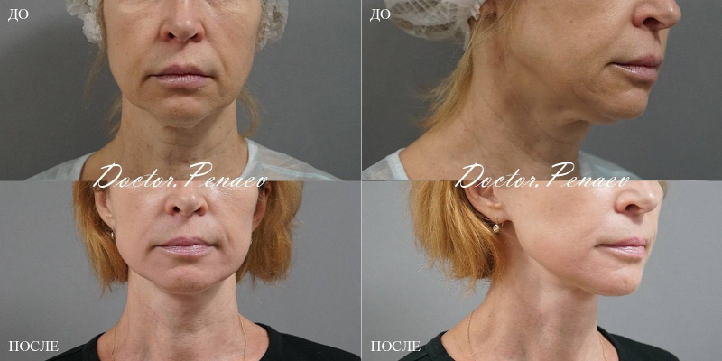 Пациентка хирурга Арслана Пенаева до и после подтяжки лица