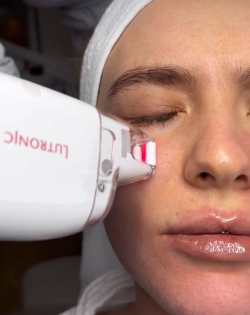 Лазерное омоложение кожи на аппарате LaseMD