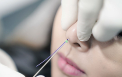 Подтяжка носа нитями