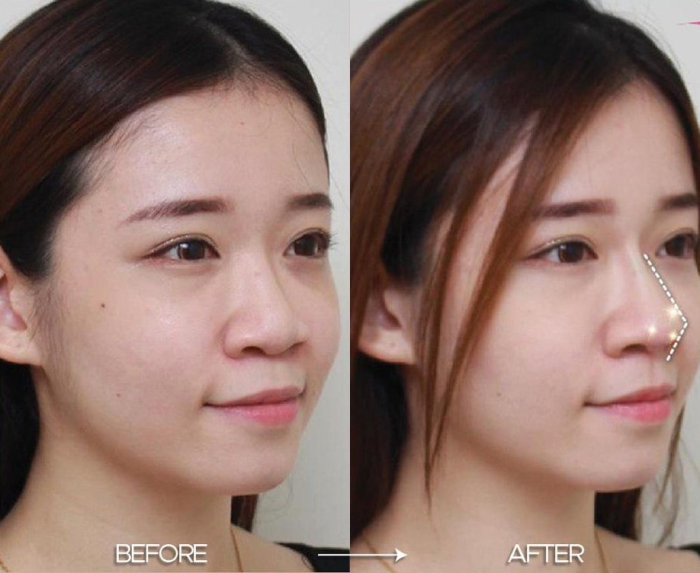 Фото пациентки до и после подтяжки носа нитями