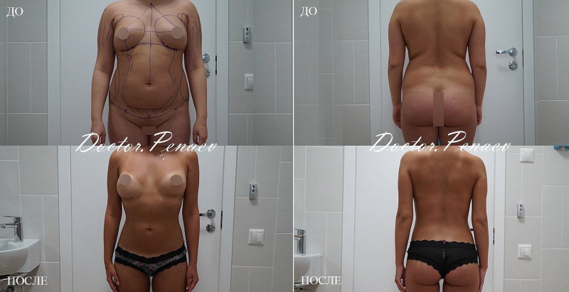 Пациентка доктора Пенаева до и после вазер-липосакции нескольких зон