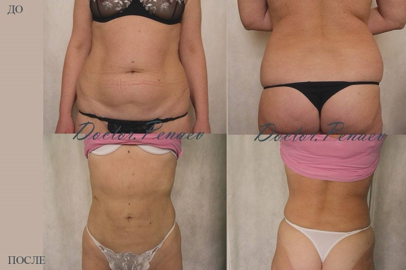 Пациентка доктора Пенаева до и после вазер-липосакции живота и спины