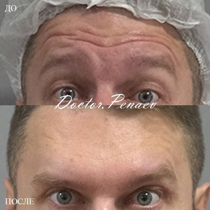 Вечный ботокс. Пациент доктора А.А. Пенаева