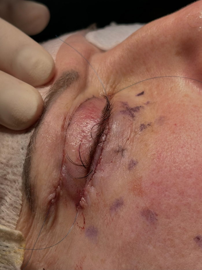 Пациентка доктора Лилит Чолоян во время круговой блефаропластики