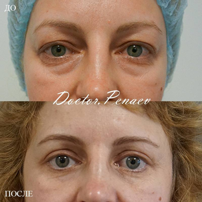 Пациентка А.А. Пенаева, 45 лет. Отвислость кожи и жировые грыжи верхних и нижних век, депрессия тканей малярной области. Выполнена блефаропластика верхних и нижних век, кантопексия, эндолазерный лифтинг маляров. Результат через три недели после операции