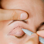 Возрастные изменения верхних и нижних век