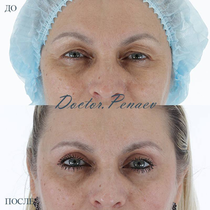 Пациентка А.А. Пенаева, 59 лет. Отвислость кожи и жировые грыжи верхних век. Выполнена блефаропластика верхних век. Результат через 6 месяцев после операции
