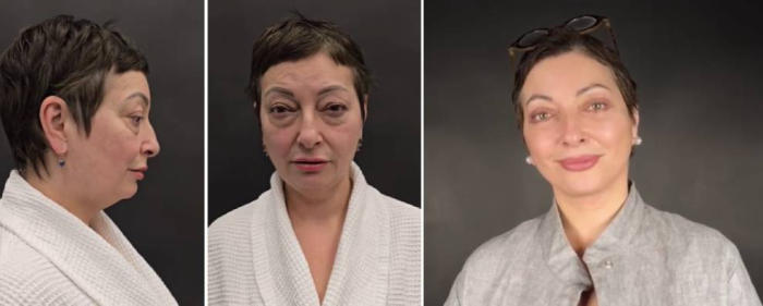 Пациентка доктора Карена Пайтяна до и после СМАС-лифтинга, совмещенного с круговой блефаропластикой. 2 недели после операции