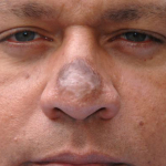 Неудачная ринопластика