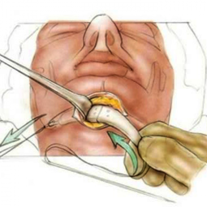 Ментопластика