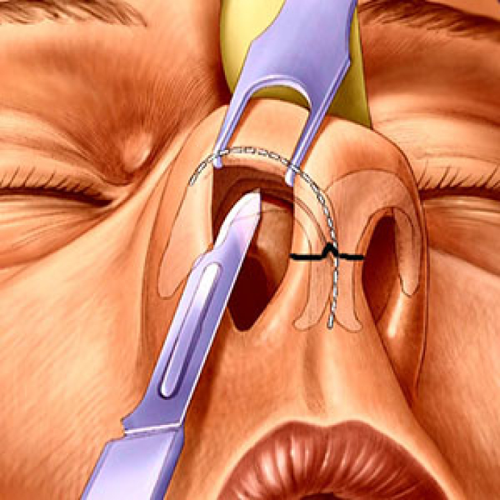 Ринопластика