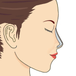 Реконструкция носа с помощью импланта