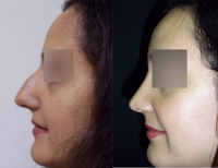 Бескровная ринопластика у Тиграна Алексаняна