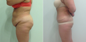 Пациентка Светланы Пшонкиной до и после абдоминопластики