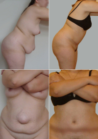 Абдоминопластика с удалением грыжи. Пациентка Светланы Пшонкиной