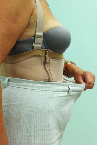 Пациентка Светланы Пшонкиной после повторной абдоминопластики