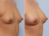 Липофилинг груди