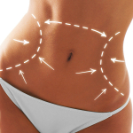 Абдоминопластика без боли