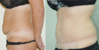 mini-abdominoplastika
