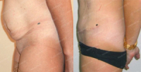 abdominoplastika