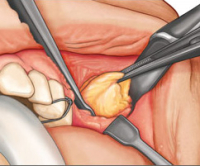 Удалить комки Биша