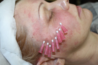 Нитевое мезоармирование