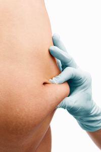 История пациента об абдоминопластике у пластического хирурга Светланы Пшонкиной