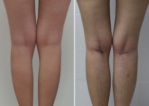 До и после круропластики у пластического хирурга Александра Гуляева